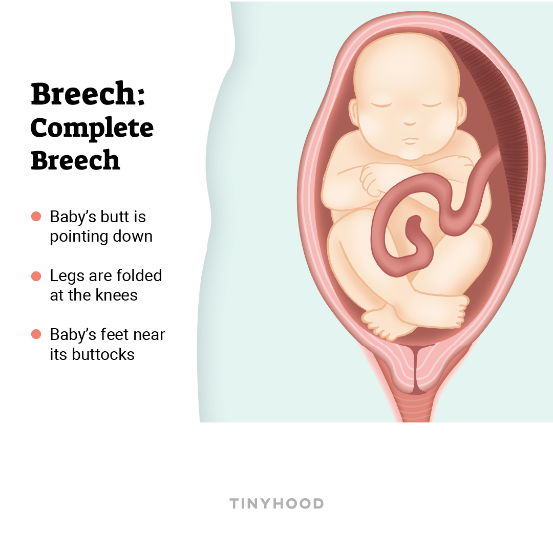 The Ultimate Guide To Fetal Positioning Tinyhood